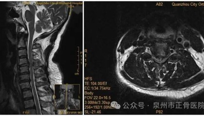 女子因手麻到医院就诊，拒绝医生颈椎手术建议，当晚翻身竟导致瘫痪，医生提醒